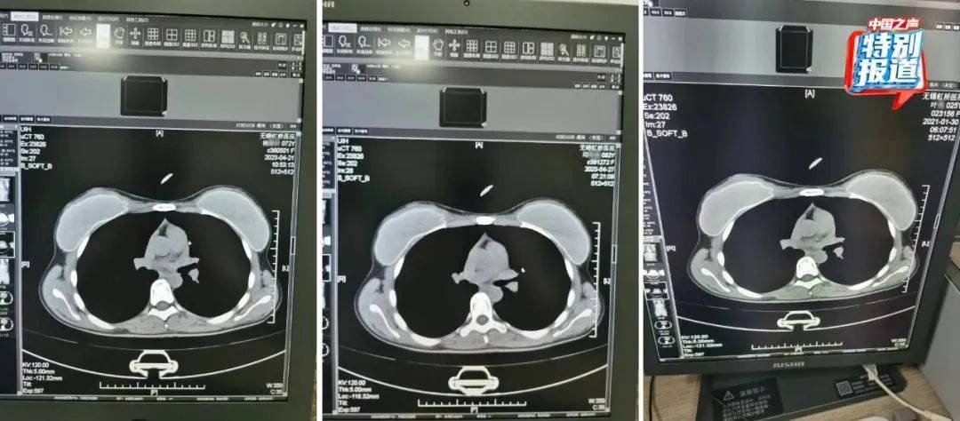 25岁、72岁、62岁三人CT片几乎一样？一医生实名举报无锡虹桥医院涉嫌骗保                