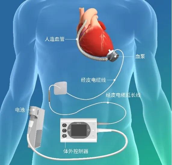 人工心脏纳入医保，全国四家医院开启试点！