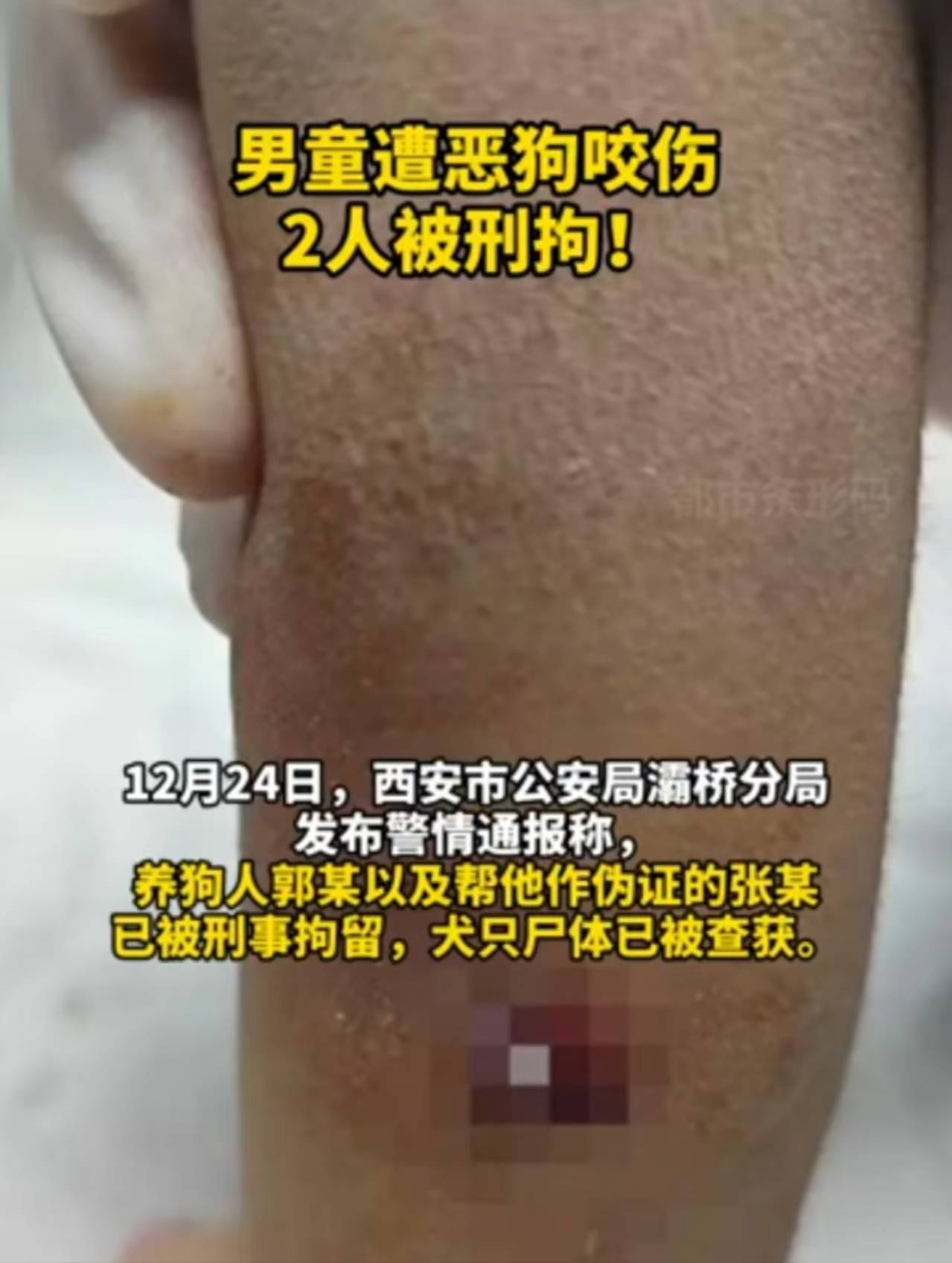 西安4岁男童遭恶犬撕咬，饲养人杀狗藏匿，另一人作假证！专家：量刑时加重处罚！                